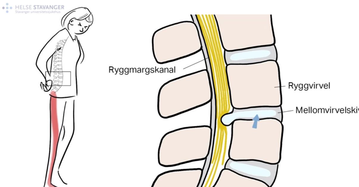 Skjermbilde fra film om prolaps