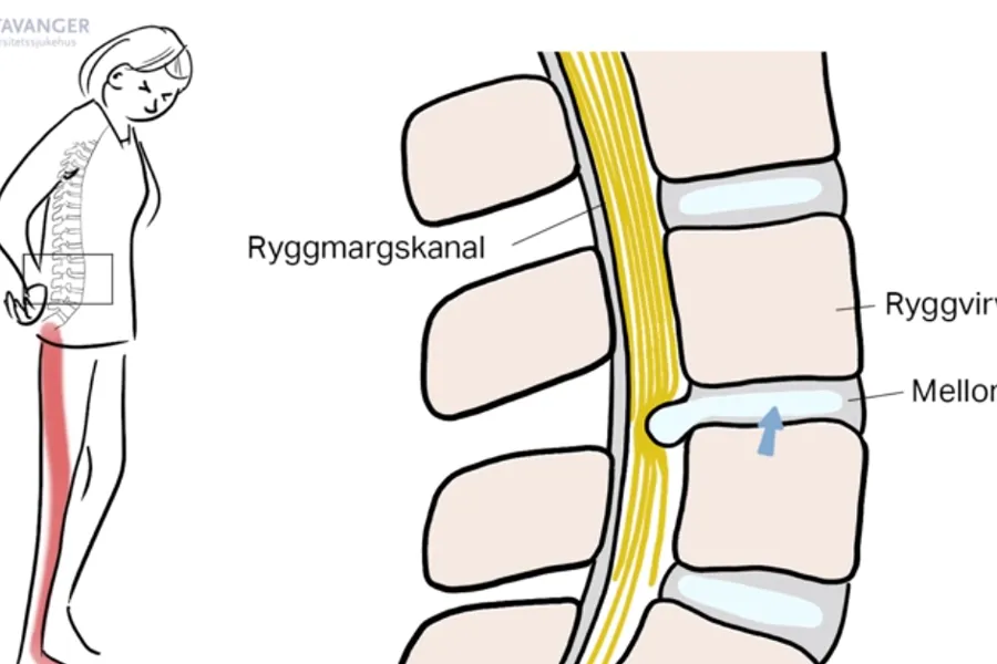 Skjermbilde fra film om prolaps