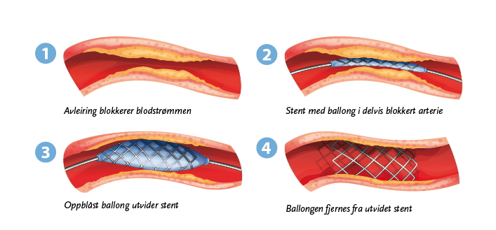 Fire ulike bilder illustrerer steg for steg hvordan invasiv kardiologi fungerer.