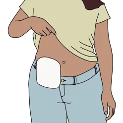 Illustrasjon av en person med stomi