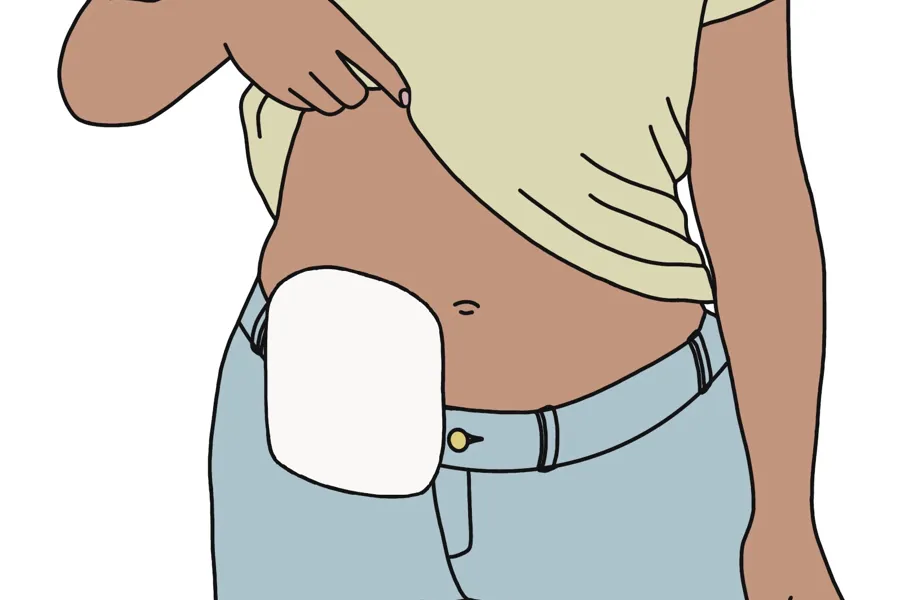 Illustrasjon av en person med stomi